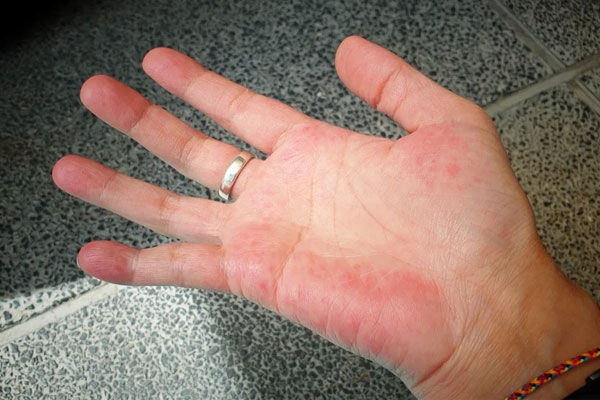 Bàn tay có thể dự báo bệnh tật: 4 dấu hiệu bất thường ở tay cảnh báo tim, gan suy yếu, ung thư ‘tìm đến’-3