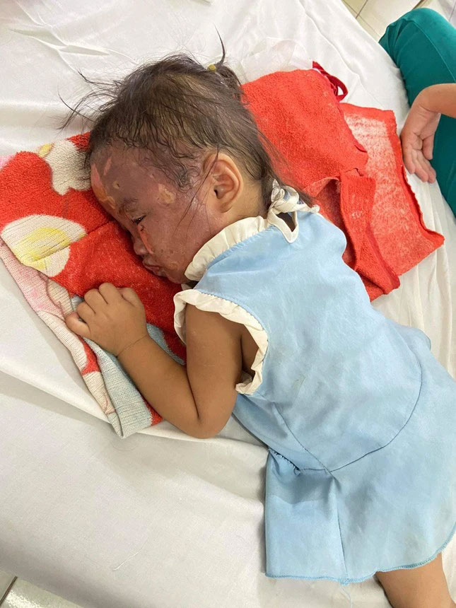 Bình Dương: Bé gái 2 tuổi bỏng nặng do nước sôi từ bình siêu tốc đổ vào mặt-1