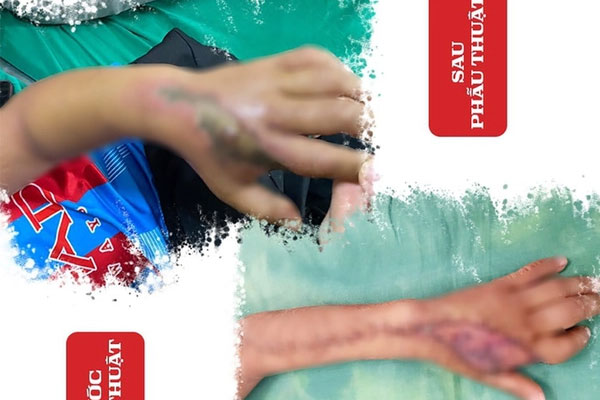 Ngủ trên lán, bé trai 8 tuổi bị rắn cắn hoại tử bàn tay-2