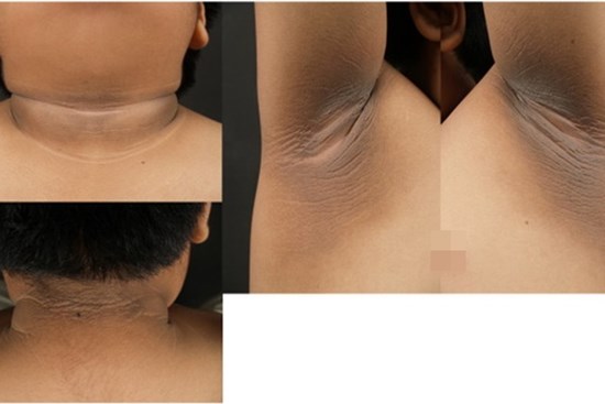 Da sẫm màu vì mắc gai đen, cảnh báo dấu hiệu của một số loại ung thư