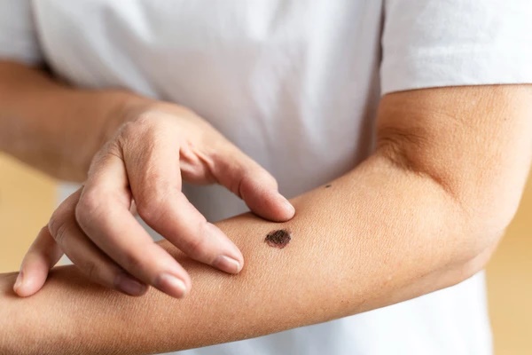 4 bộ phận trên cơ thể chuyển màu đen sạm cảnh báo tế bào ung thư-2