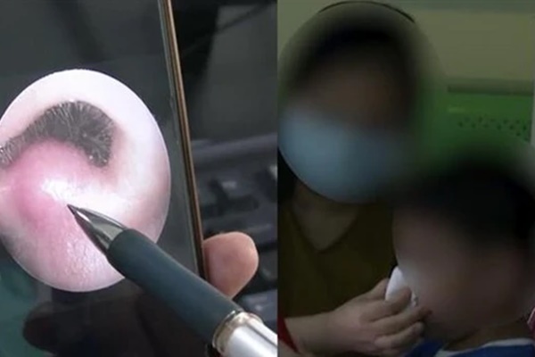 Bé 8 tuổi nhiễm trùng nội sọ, suýt mất mạng vì 1 thói quen khi rảnh rỗi-1