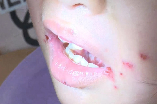 TP. Hồ Chí Minh: Số ca mắc sốt xuất huyết, tay chân miệng đều giảm-1