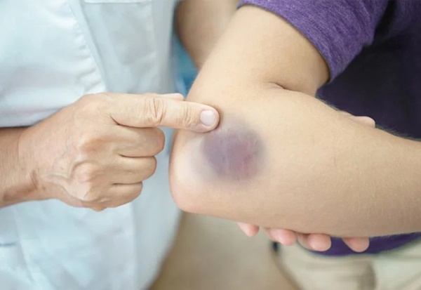 Diễn viên Châu Hải My qua đời, cơ thể đầy vết bầm tím: Nguyên nhân nào xuất hiện vết bầm tím?-2