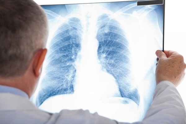 Bụi phổi khiến nhiều công nhân tử vong ở Nghệ An: Căn bệnh nghề nghiệp để lại nhiều di chứng nặng nề cho người lao động-2