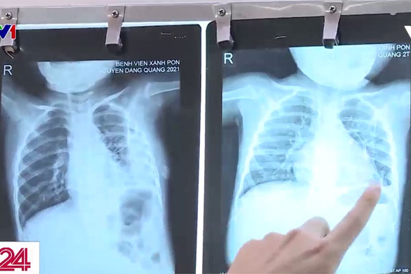 Cảnh báo nhiều trẻ viêm phổi do vi khuẩn tụ cầu-2