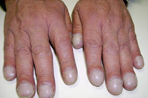 Ung thư phổi có thể phát dấu hiệu cảnh báo ở tay: Chuyên gia nhắn nếu thấy phải đi khám-1