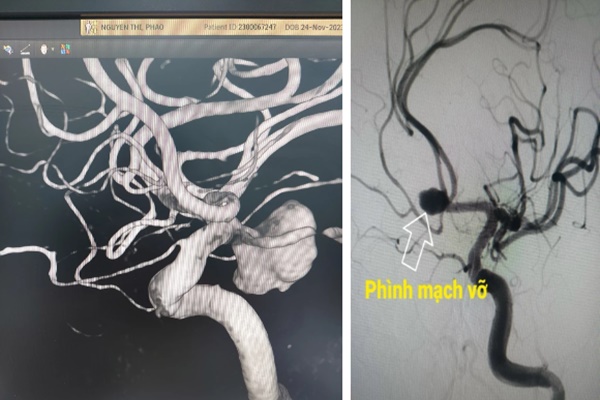 Cảnh giác với cơn đau đầu thường gặp ở người trẻ: Nguy cơ vỡ phình động mạch não-1