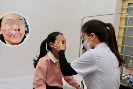 Bé gái 11 tuổi suýt hỏng mắt vì tự chế pháo bằng diêm