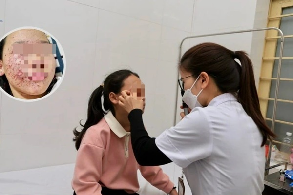 Bé gái 11 tuổi suýt hỏng mắt vì tự chế pháo bằng diêm-1