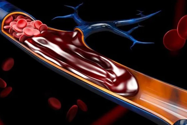 Người có cục huyết khối trong máu thường có 4 dấu hiệu khi ngủ, bỏ ra 5 giây kiểm tra sẽ giúp bạn phòng ngừa đột quỵ-1