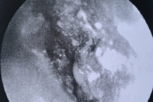 TPHCM: Hàng chục người bị hủy xương tai vì bệnh ác tính tỷ lệ tử vong cao-1