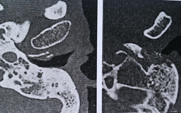TPHCM: Hàng chục người bị hủy xương tai vì bệnh ác tính tỷ lệ tử vong cao-2