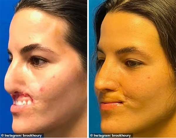 Nữ người mẫu bị chó dữ cắn mất môi trên và hành trình chữa lành gây cảm phục-2