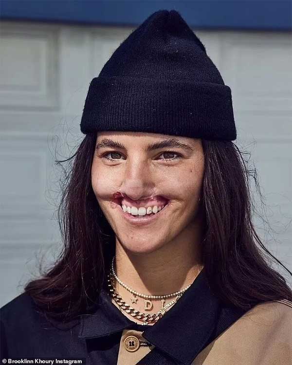 Nữ người mẫu bị chó dữ cắn mất môi trên và hành trình chữa lành gây cảm phục-3