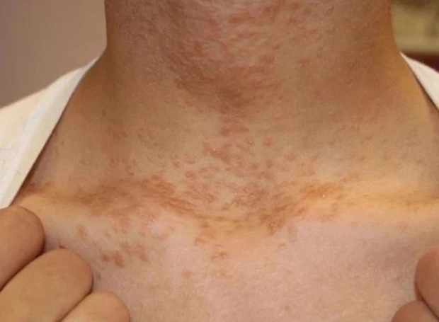 4 bất thường ở cổ cảnh báo ung thư nhưng hầu hết mọi người không để ý-1