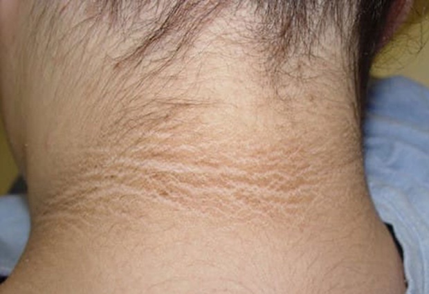 4 bất thường ở cổ cảnh báo ung thư nhưng hầu hết mọi người không để ý-2