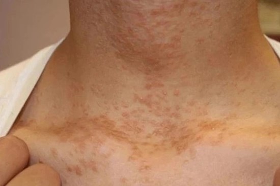 4 bất thường ở cổ cảnh báo ung thư nhưng hầu hết mọi người không để ý