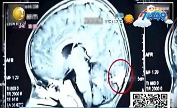 Bất ngờ phát hiện 5000 ký sinh trùng trong người, đã ăn phổi và não khi đi khám xương khớp-1