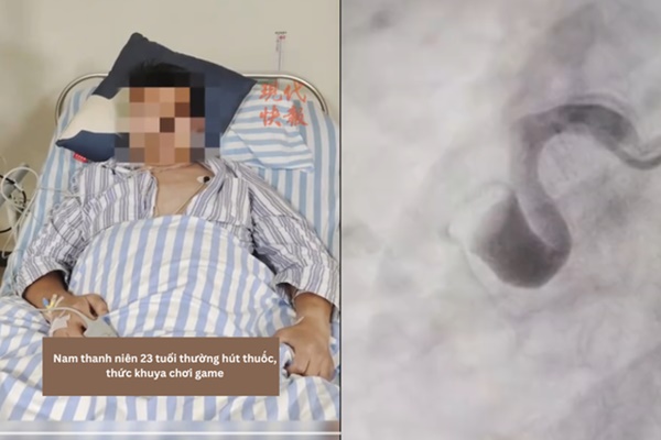 Chạy bộ trời lạnh bị đau ngực: Coi chừng 3 tình trạng nguy hiểm-3