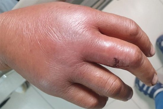 Tay căng phồng, nhiễm khuẩn cấp vì 