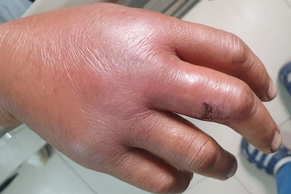 Tay căng phồng, nhiễm khuẩn cấp vì thủ phạm ở hàng rào-1