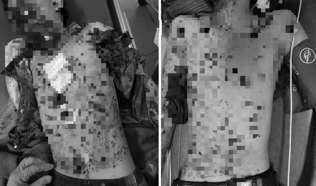 2 học sinh lớp 9 tại Lâm Đồng nguy kịch vì tự chế tạo pháo-1