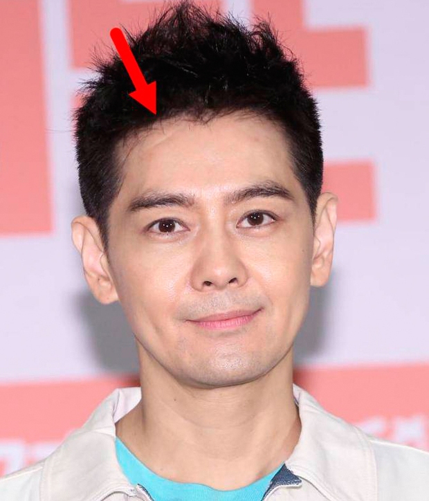 Xót xa hình ảnh Lâm Chí Dĩnh lộ khuôn mặt lồi lõm sau tai nạn xe nghiêm trọng-3