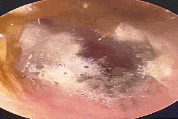 Đau tai đi khám, bác sĩ sốc nặng khi thấy thứ trong tai người đàn ông-1