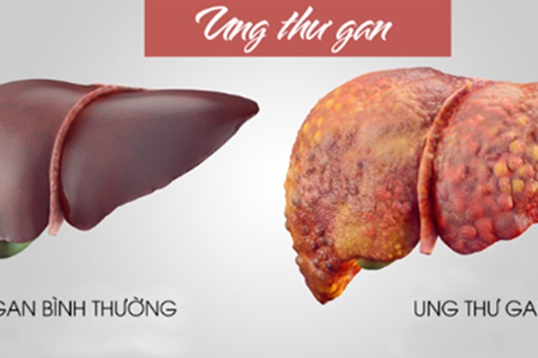 Chàng trai 29 tuổi qua đời vì ung thư gan dù tập thể dục hàng ngày: Bác sĩ chỉ ra 3 thói quen tai hại, nhiều người biết nhưng vẫn làm-5