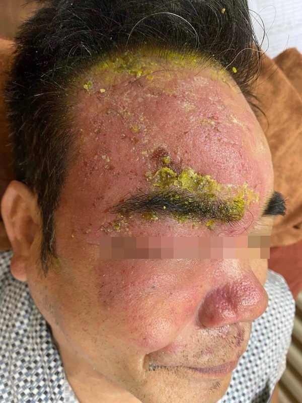 Mắt tổn thương nặng vì đắp đậu xanh chữa zona thần kinh-1