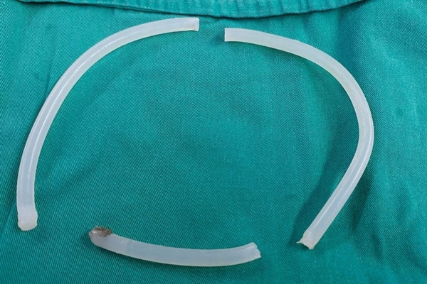 Cấp cứu người đàn ông tự đẩy 40 cm keo nến vào niệu đạo-1