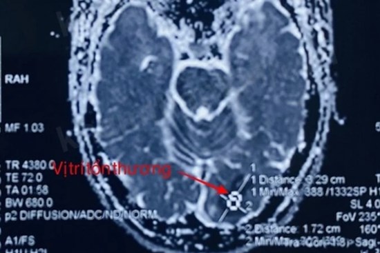 Chàng trai 27 tuổi bị đột quỵ sau tắm