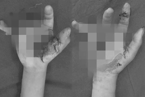 Chơi pháo tự chế, 3 thiếu niên bị nổ nát tay-1