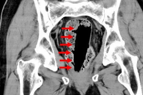 Người đàn ông bất tỉnh trong bồn tắm khi chữa táo bón bằng cách kinh dị-1
