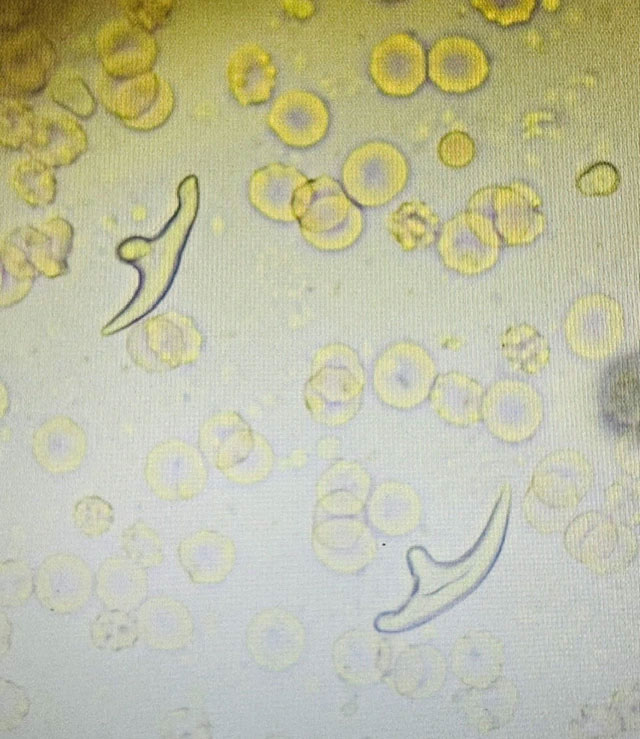 Đau ngực, khó thở, người đàn ông đi khám và phát hiện thủ phạm bất ngờ trong phổi-1