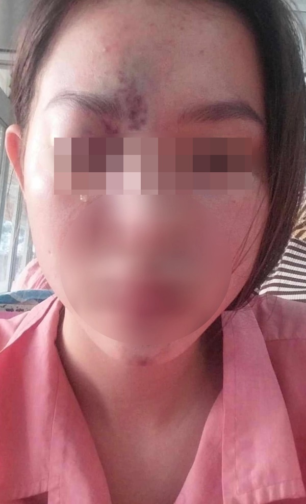 Thiếu nữ 17 tuổi mù mắt vĩnh viễn, liệt nửa não trái sau tiêm filler nâng mũi: Đừng quên 4 điều để an toàn khi làm đẹp-2