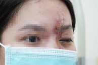 Cô gái 18 tuổi mù mắt sau tiêm filler, nhân viên spa nói... 'tụt huyết áp'