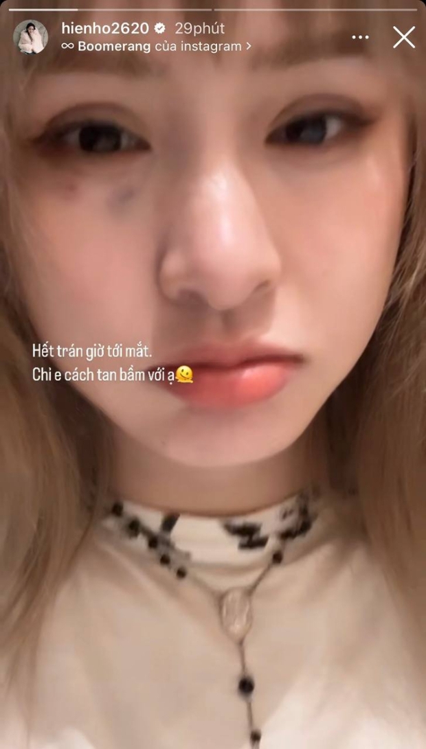 Hiền Hồ lộ diện với vết bầm lớn trên mặt, lại là chiêu trò PR sản phẩm mới?-1