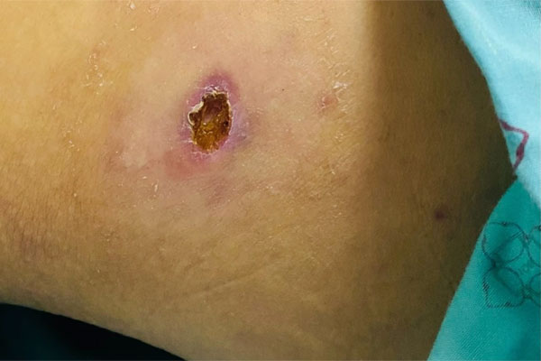 Vết loét nhỏ trên da cảnh báo căn bệnh nguy hiểm-1