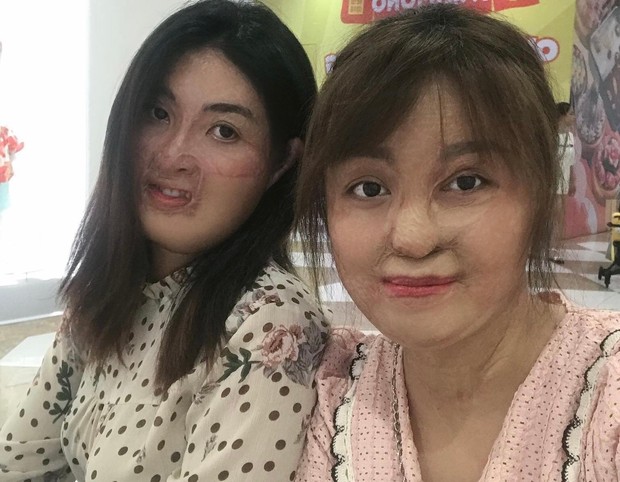 Sau 20 lần mổ, cô gái bị chồng đổ xăng đốt hôm mùng 2 Tết hiện ra sao?-1