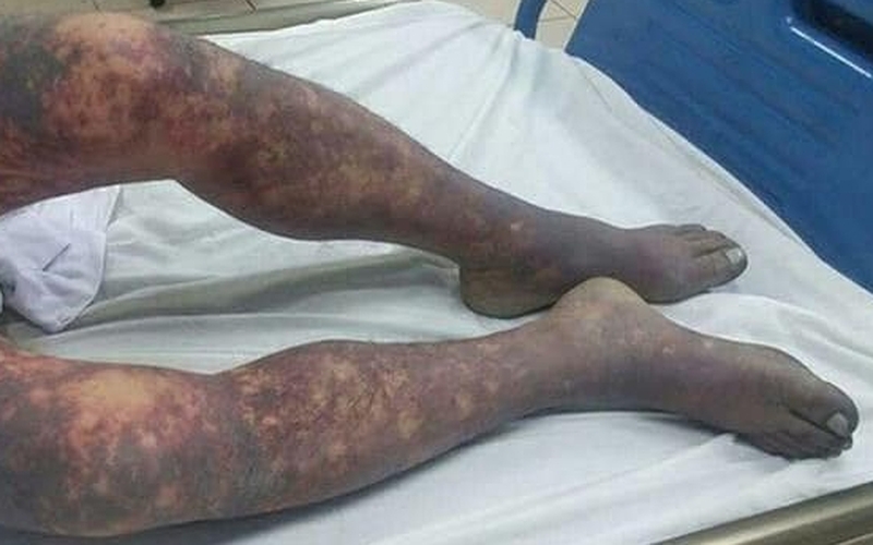 Tử vong sau khi ăn tiết canh lợn liên hoan tất niên-1