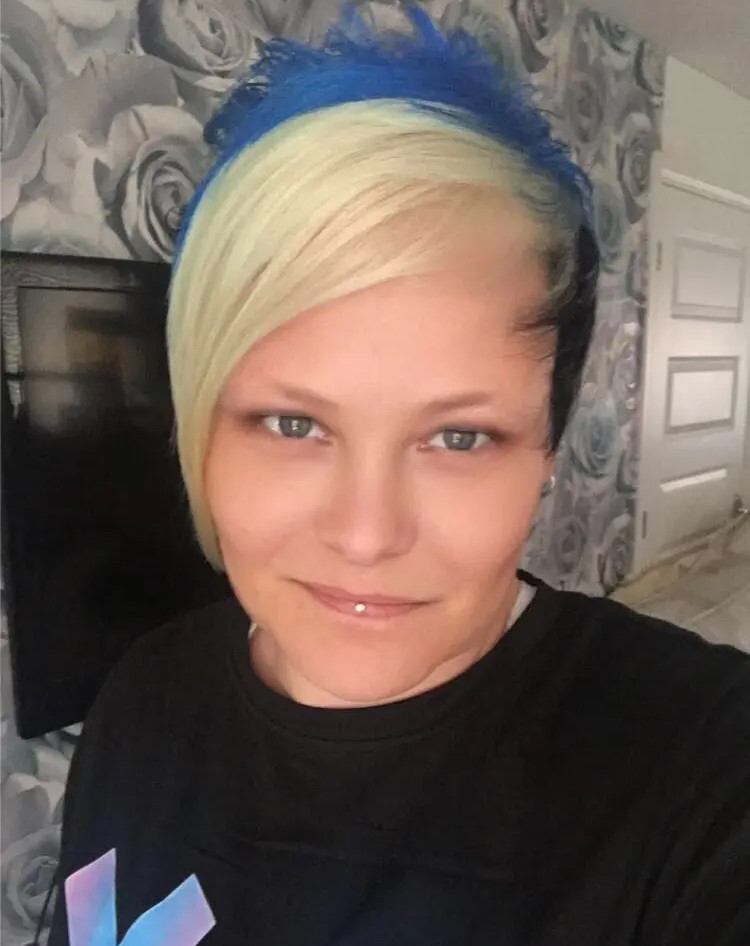 Một vết xước khiến người phụ nữ phải phẫu thuật 55 lần-1