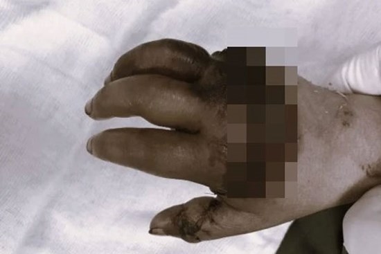 Bé trai bị xích xe máy nghiến đứt lìa bàn tay