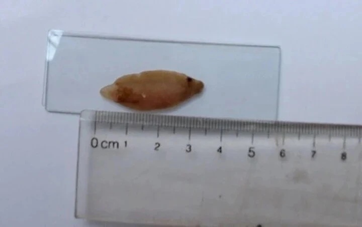 Suýt bị cắt gan do nhầm sán là ung thư-1