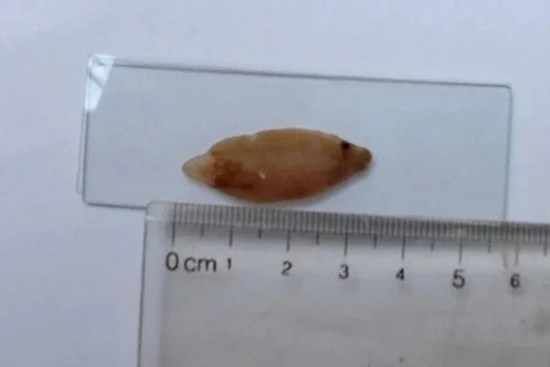 Suýt bị cắt gan do nhầm sán là ung thư