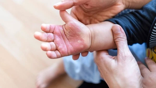 Phòng ngừa tai nạn thương tích cho trẻ dịp Tết-1