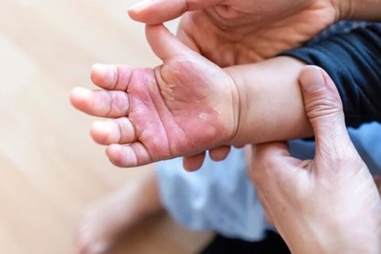 Phòng ngừa tai nạn thương tích cho trẻ dịp Tết