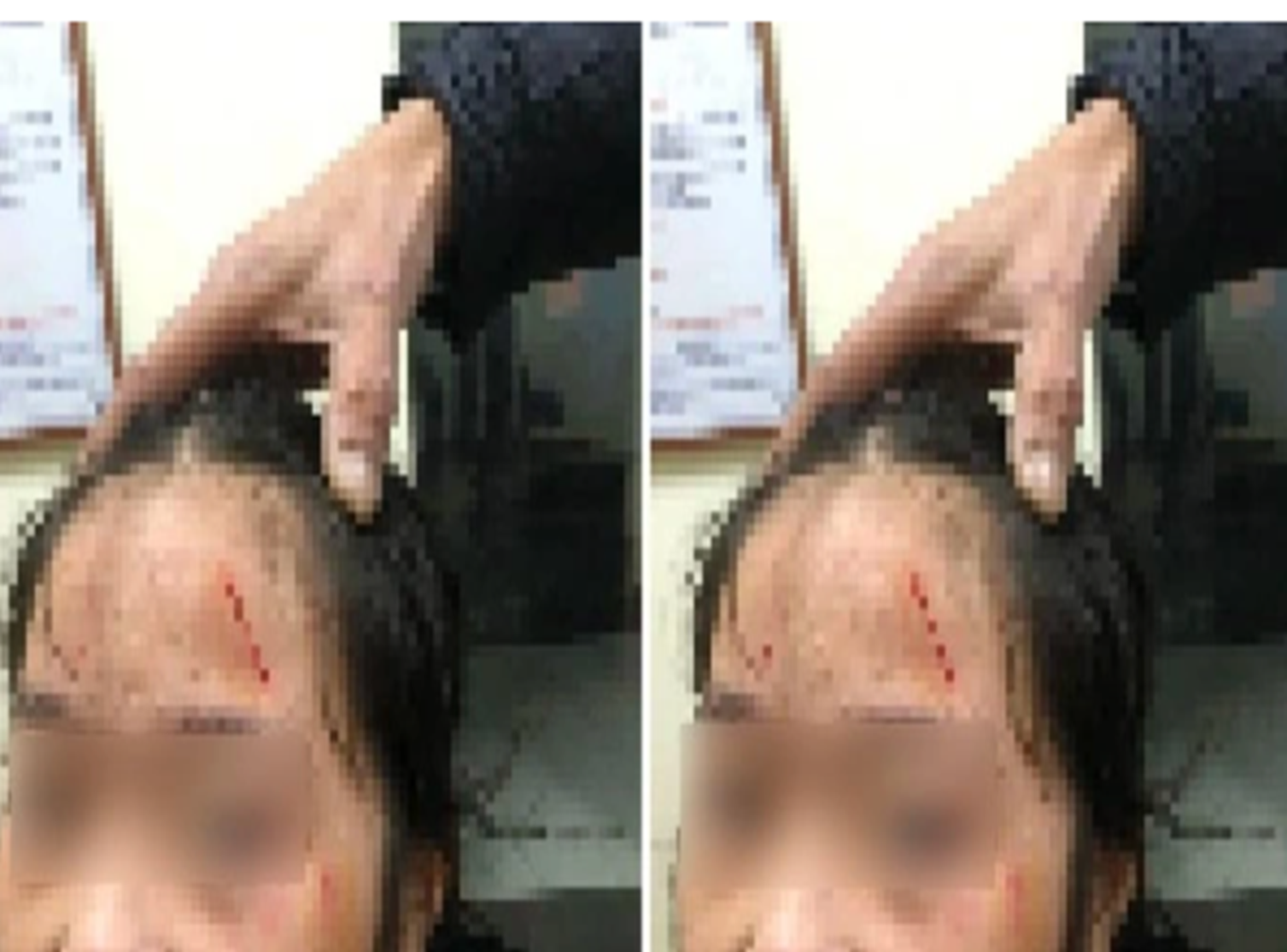 Vụ nữ sinh lớp 6 bị bạn bạo hành dùng dao rạch lên mặt: Người mẹ xót xa trước sự hoảng loạn của con gái-1