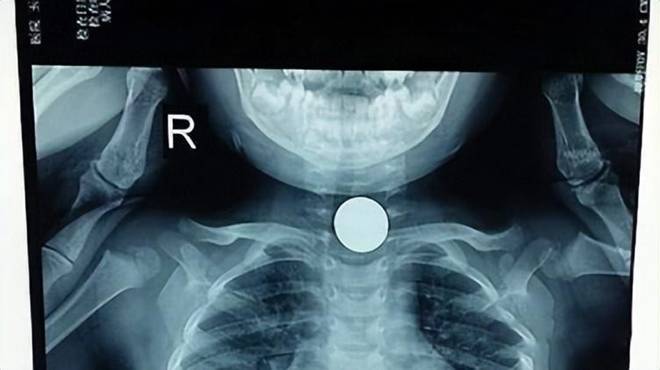 Con gái 3 tuổi đang chơi với bố trên giường thì bất ngờ nôn mửa, đưa đến bệnh viện bác sĩ nói Đã muộn-2